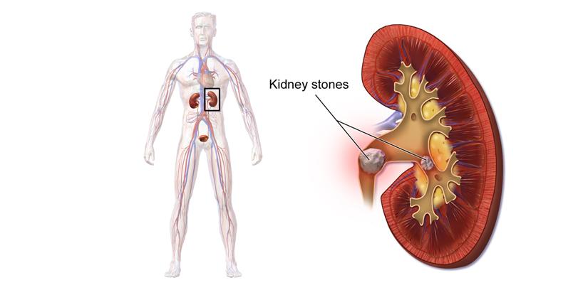 What causes Kidney Stone | Treatment & diet for a kidney stone patient - ‘4 minutes read’